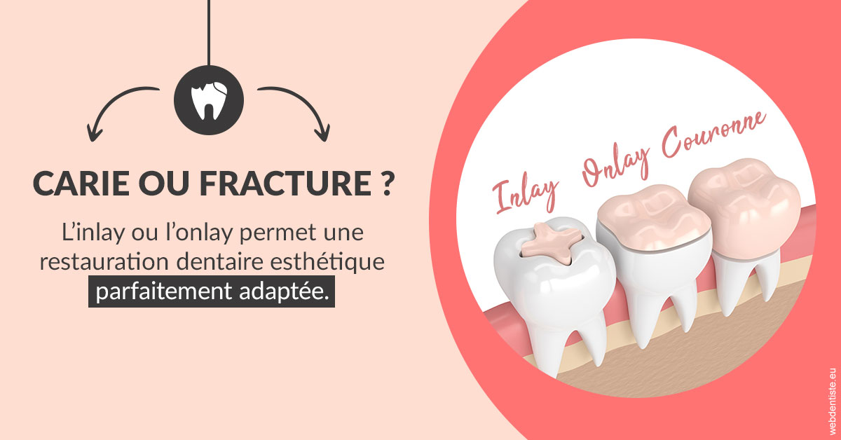 https://selarl-chirdentiste-drherve.chirurgiens-dentistes.fr/T2 2023 - Carie ou fracture 2