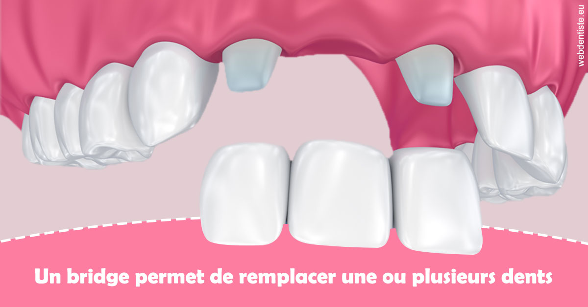 https://selarl-chirdentiste-drherve.chirurgiens-dentistes.fr/Bridge remplacer dents 2