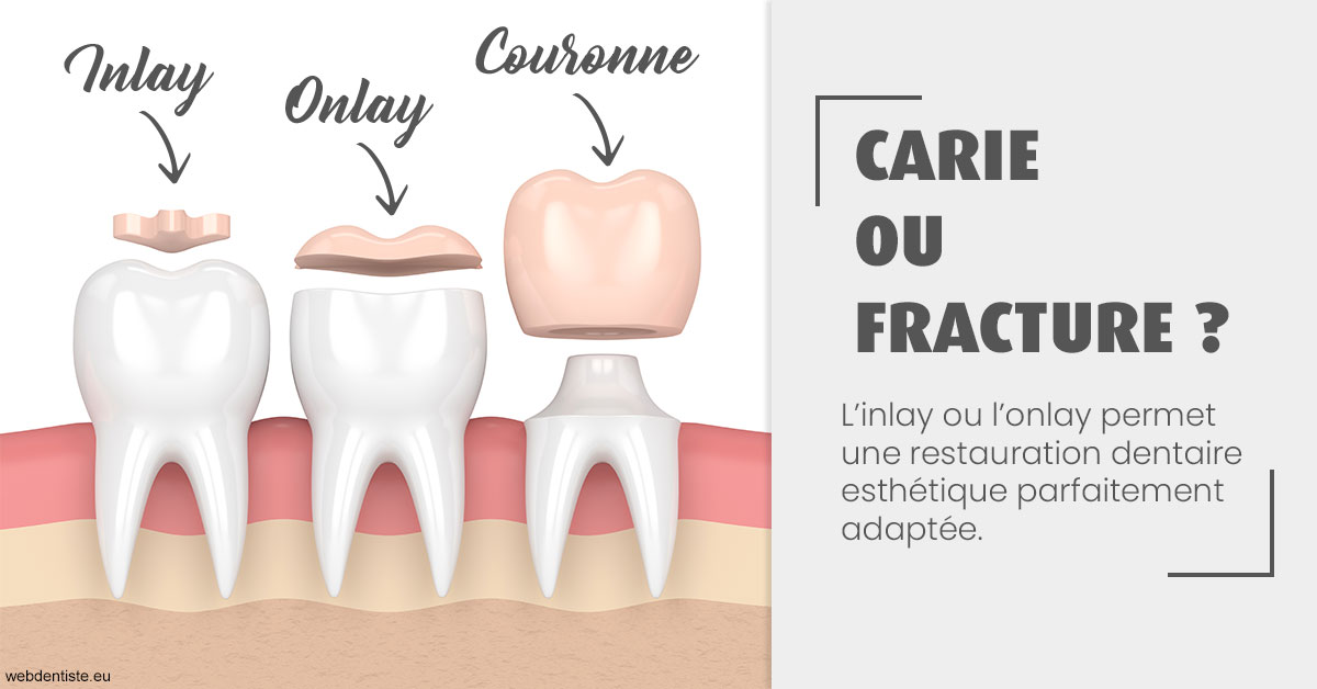 https://selarl-chirdentiste-drherve.chirurgiens-dentistes.fr/T2 2023 - Carie ou fracture 1