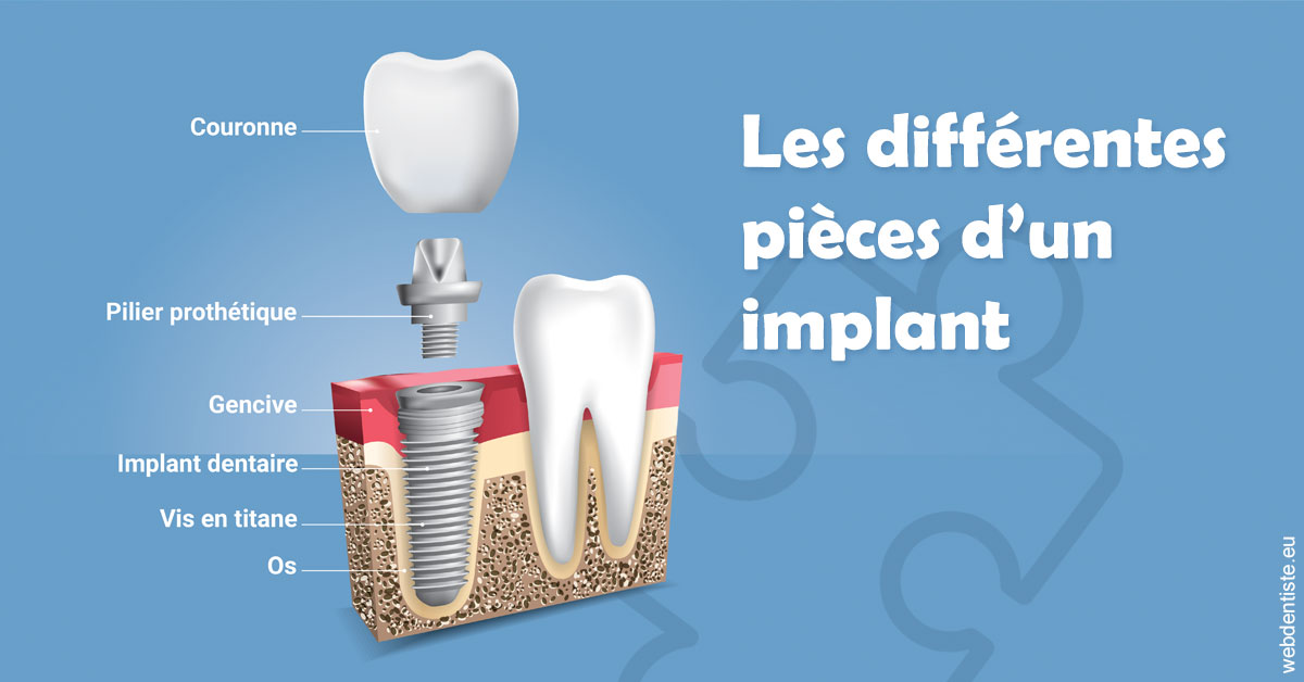 https://selarl-chirdentiste-drherve.chirurgiens-dentistes.fr/Les différentes pièces d’un implant 1